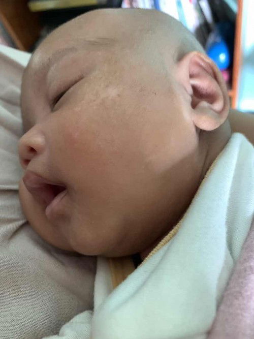 Bercak putih di wajah