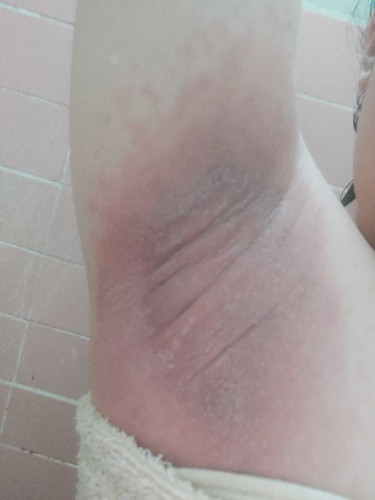 Underarm rashes?