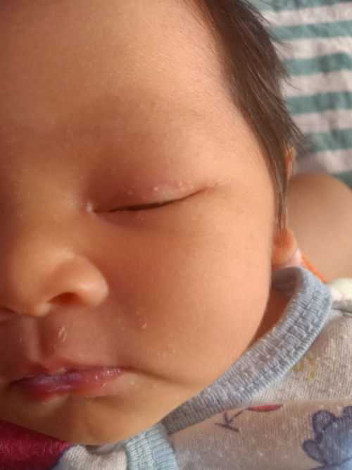 ลูกเป็นตุ่มที่เปลือกตา