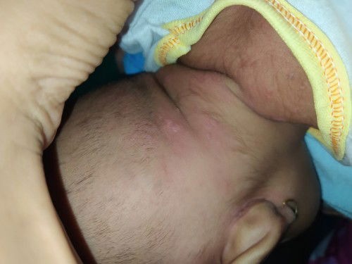 Menghilangkan lanugo bayi


Kulit bayi 2 bulan sperti ini