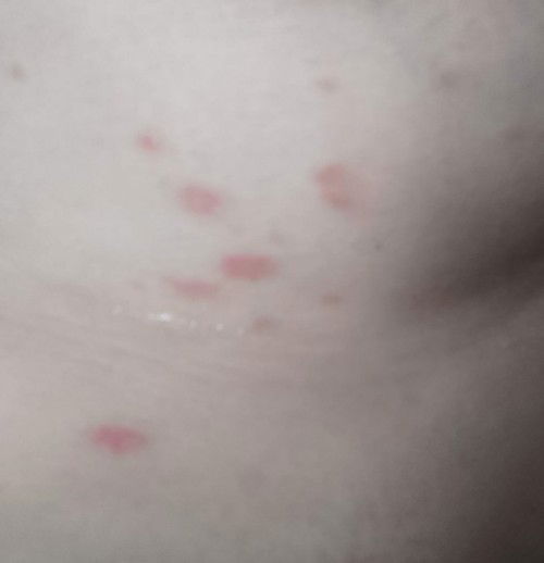 Merah-merah di bawah payudara