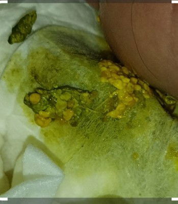 bayi kolik bab wrna hijau kuning