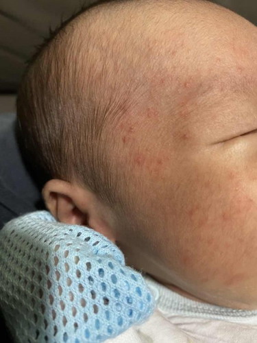 Any mummies know what is this red spots on baby face?