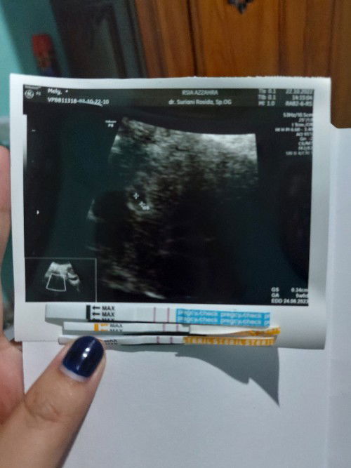 Saya usg 5 wekk uda ad kantungny ,7 wekk mw cek lagi tpi agak"was" bgt ngk tw knpa