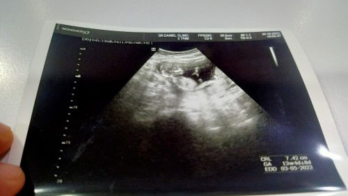 จากเด็กน้อยที่แม่กลัวท้องนอกมดลูก สู่เด็กน้อย 13W  ในวันนี้