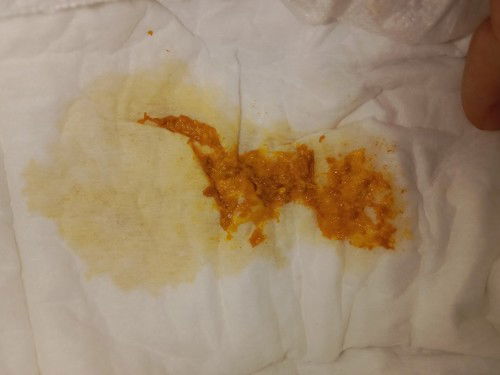 ลูกอึแบบนี้ผิดปกติมั้ยคะ