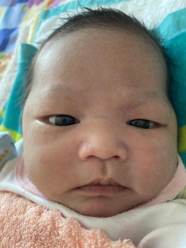ลูกผื่นขึ้นที่หน้า