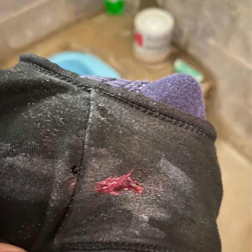 ขออภัยในภาพที่ไม่เหมาะสมถามแม่ๆค่ะไปกระตุ้นมาวันนี้กับมาแล้วเป้นแบบไหนภาพควรไปหาหมอไหมหรือรอก่อนค่ะ