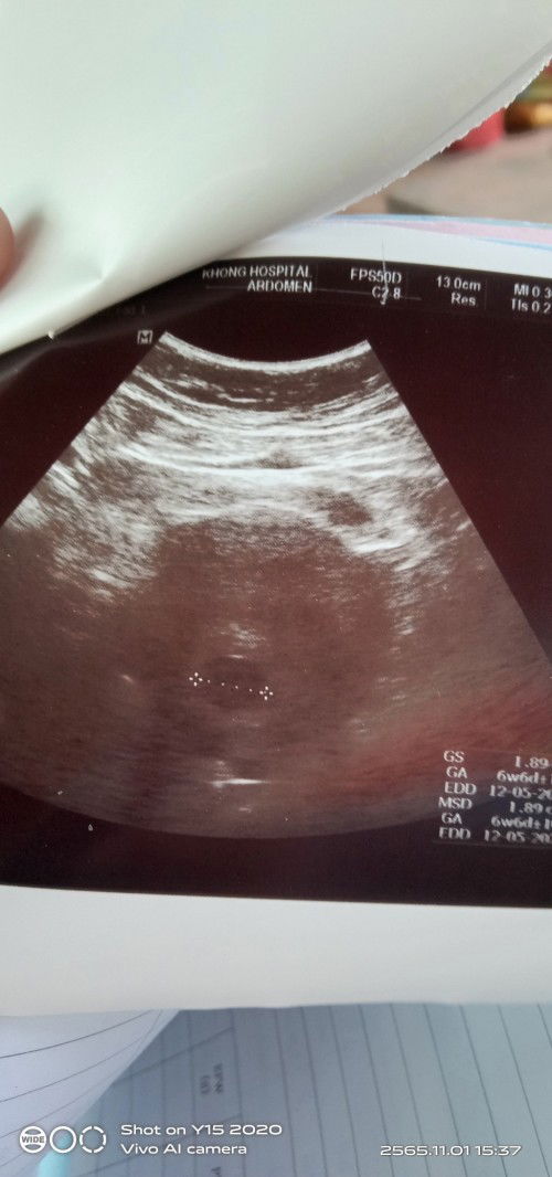 ภาวะท้องลมไม่เคยคิดจะเกิดขึ้นกับตัวเอง