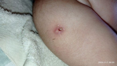 Luka habis imunisasi