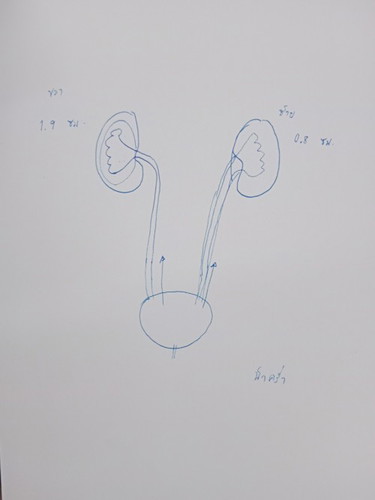 กรวยไตโตกว่าเกณฑ์ปกติ