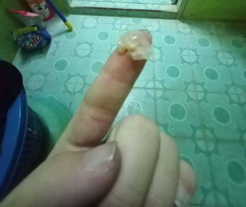 ขออนุญาตค่ะอายุครรภ์39สัปดาห์มีหมูกใสไหลออกมาบวกกับอาการท้องปั้นแข็นนี้คืออาการใกล้คลอดไหมค่ะ