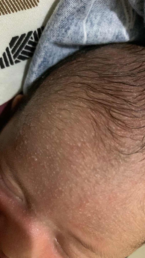 biang keringat pada bayi