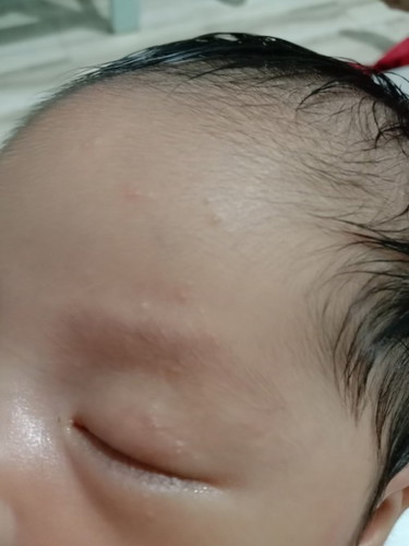 Butlig sa mukha. Delikado po ba?