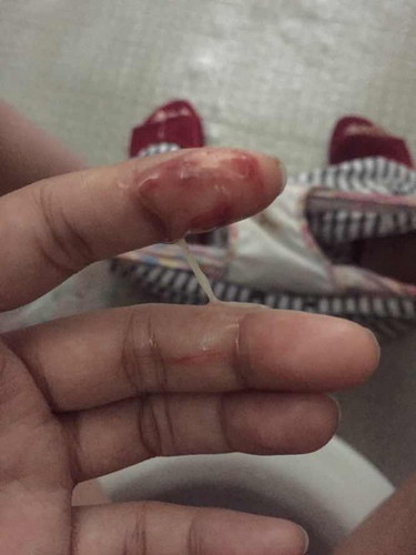 Is this Mucus plug?