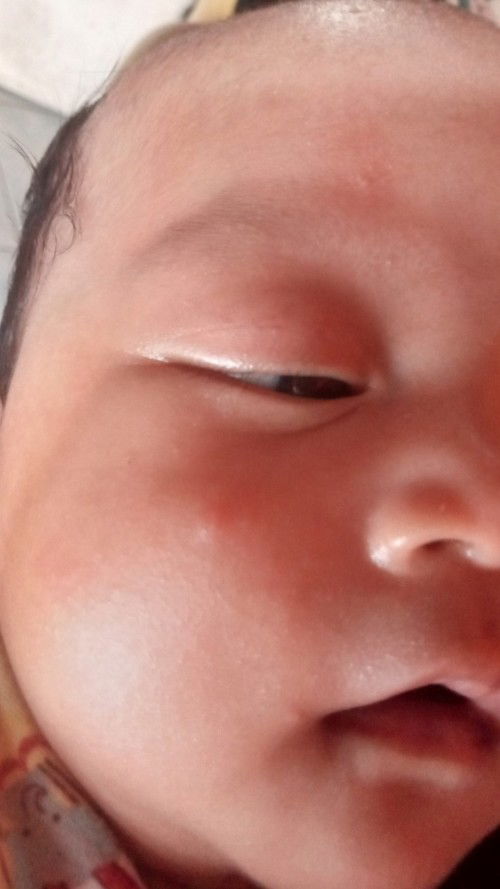 Muka bayi merah merah & bentol