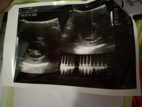 Sakit di bagian pinggang