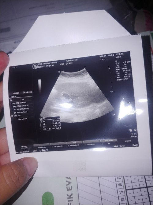 Hamil 10 minggu tapi tidak terlihat janin