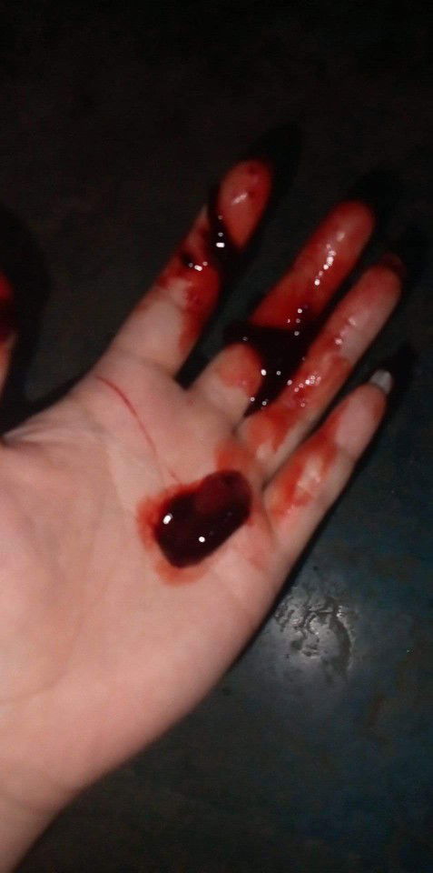 เลือกออกเป็นก้อน