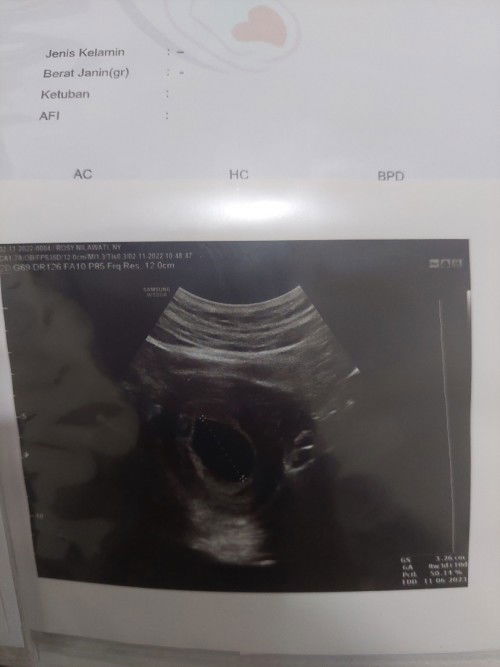 Usia 9 week tapi janin dan djj belum ada
