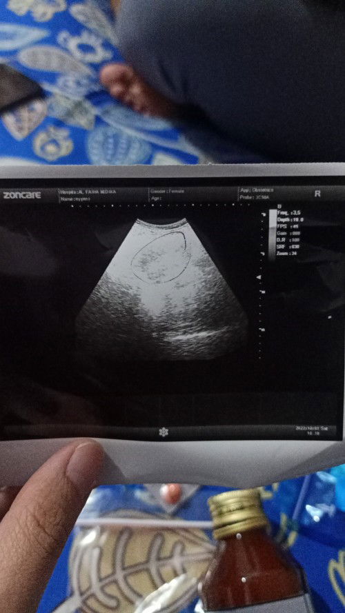 5week masih penebalan rahim