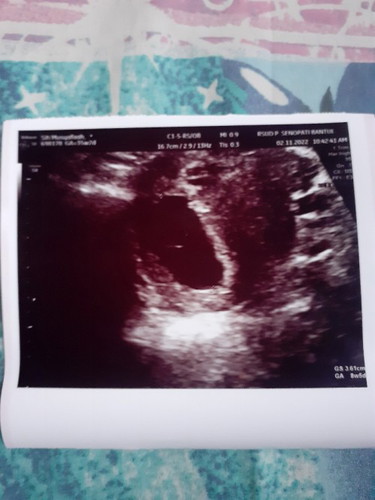 Td saya usg di uk 9w tapi cuma kelihatan kantung nya aja, apa bunda2 ada yg pernah ngalamin ?