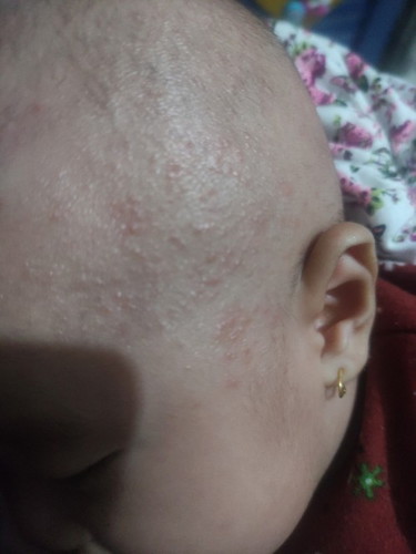 Menyembuhkan biang keringat bayi di kapala botak