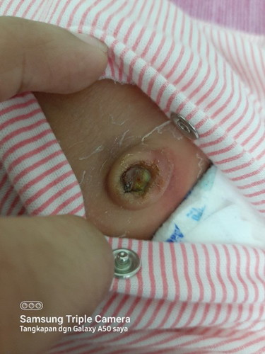 Pusat baby berbau 1 minggu pusat bru jatuh