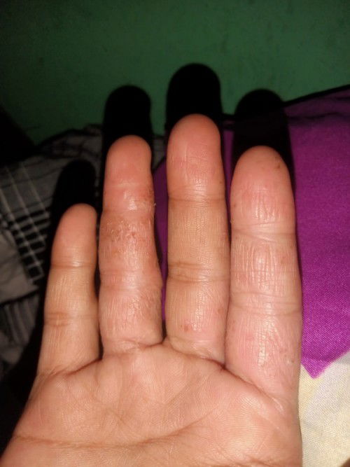 Info nya bund obat salep alergi di tangan ber air disertai gatal sama perih gtu😪
Lagi hamil 26mnggu