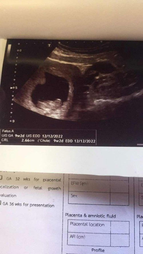 ผลอัตซาว กำหนดคลอดไม่เหมือนครั่งแรก