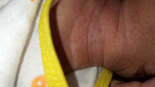 Leher bistik bistik merah