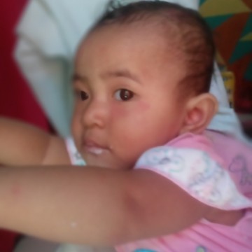 ada yg sama gk kaya anak sy muncul ruam merah di wajah,kasi obat apa ya bun, atau bagaimana.
