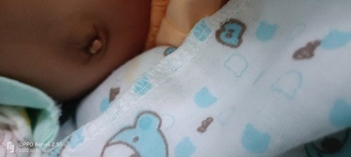 ลูกใครมีสะดือเเบบนี้บ้างค่ะ
มีวิธีแก้แบบไหนบ้างค่ะ