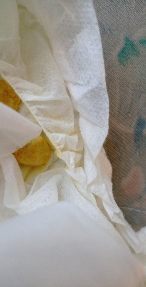 อึแบบนี้ควรหาหมอมั้ย