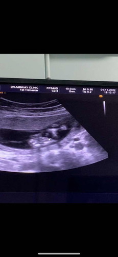 อายุครรรภ์14วีค อยากรู้เพศลูก