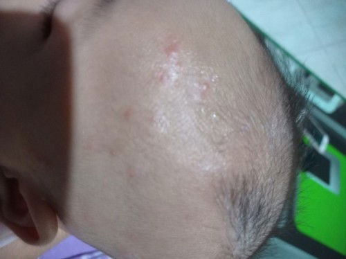 Kepala bayi bentol merah