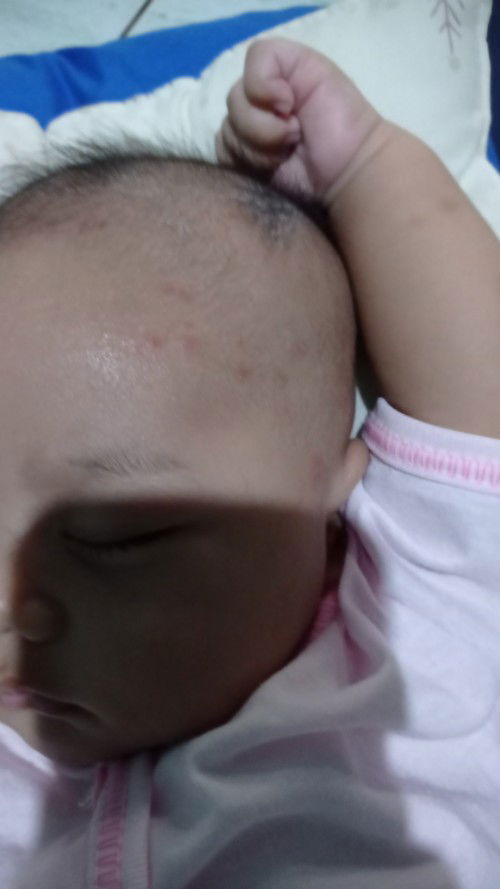 Bentol merah pada kepala bayi