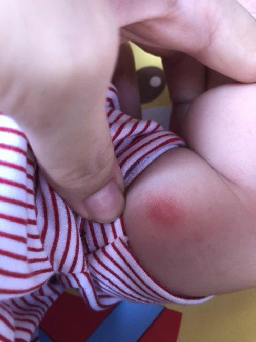 Bentol besar pada kulit bayi