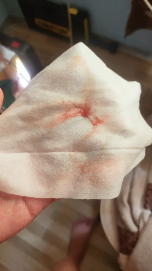 Ano pong discharge ito???