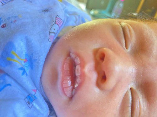 สอบถามแม่ๆปากน้องแห้งแบบนี้มีวิธีทำให้หายแห้งไหม