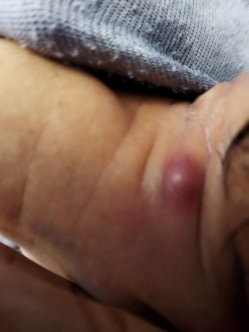 นี่ใช่ฝีไหมคะ พอดีขึ้นที่คอของลูก จะอันตรายไหมคะ