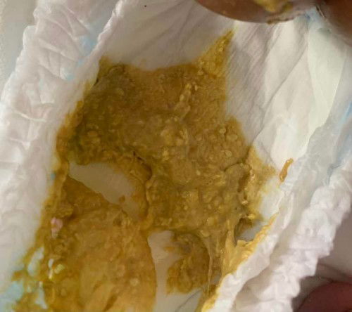 อุจจาระแบบนี้ปกติมั้ย