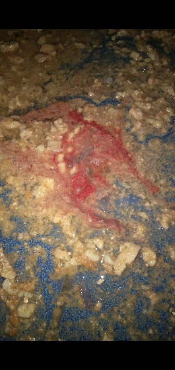 Muntah berdarah saat hamil