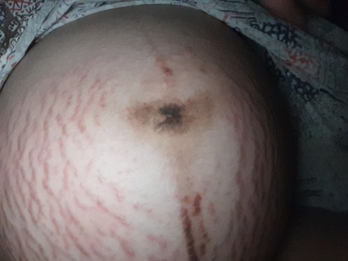 Anu po ang pwede I recommend sa pag alis ng stretch marks