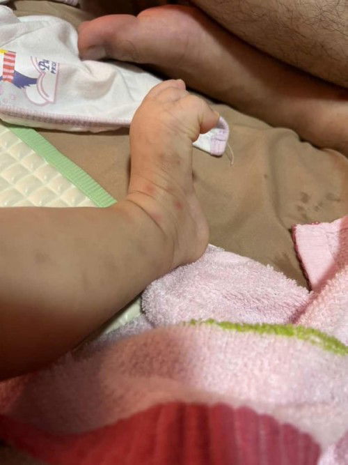 Badan anak 6 bulan tumbuh ruam setelah demam