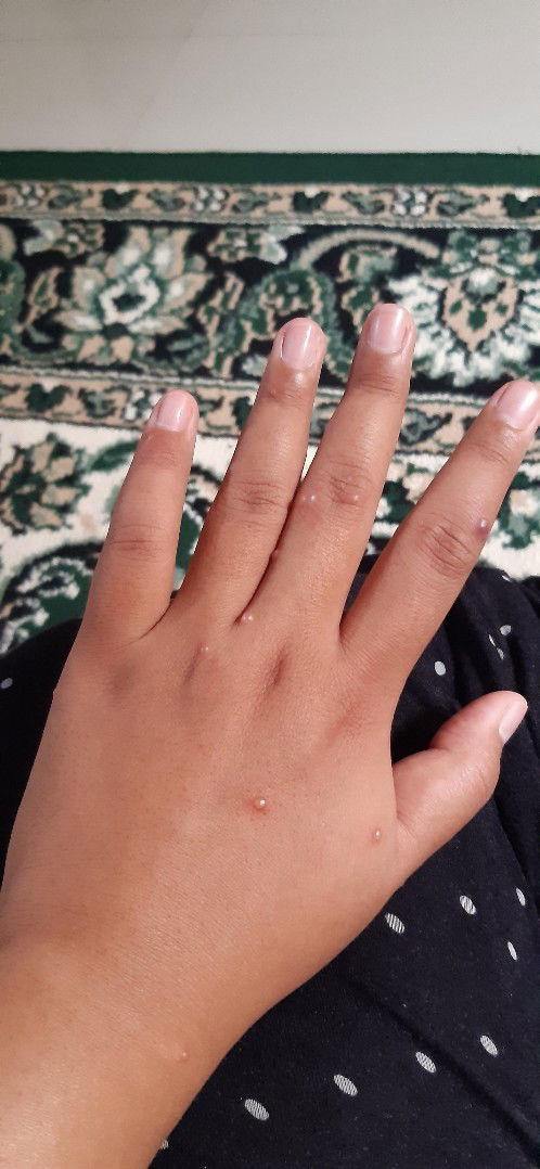 Curhat kena Cacar saat UK 37 minggu