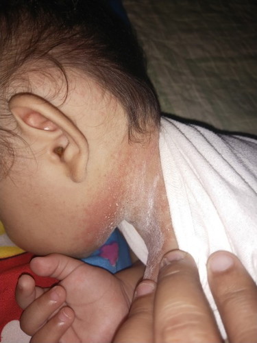 RASHES SA LEEG.
