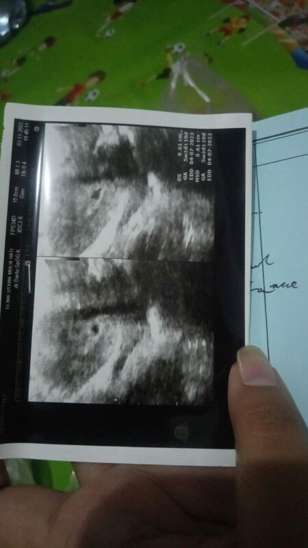 Hi Bun aku hamil klo menurut hpht udh 7w2d tp di USG 5w2d aku pendarahan 2 hari ada yg sama g bun?