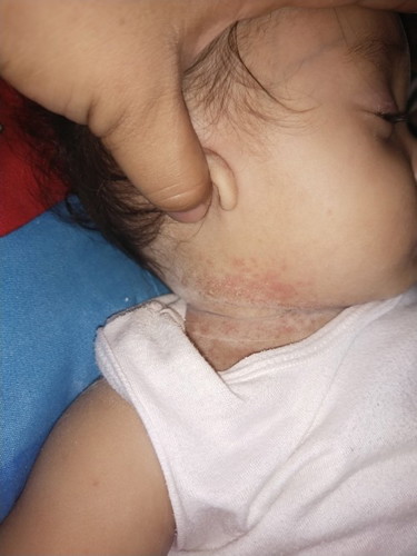 Rashes sa Leeg