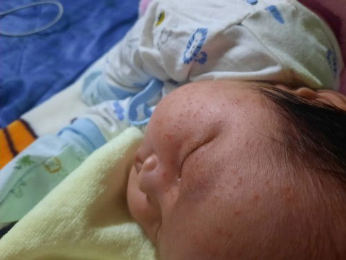 Bê mình bị Zay là bị gì vậy các mom, bé mới sinh được 10 ngày , sợ da còn non qá ko sức gì dx,